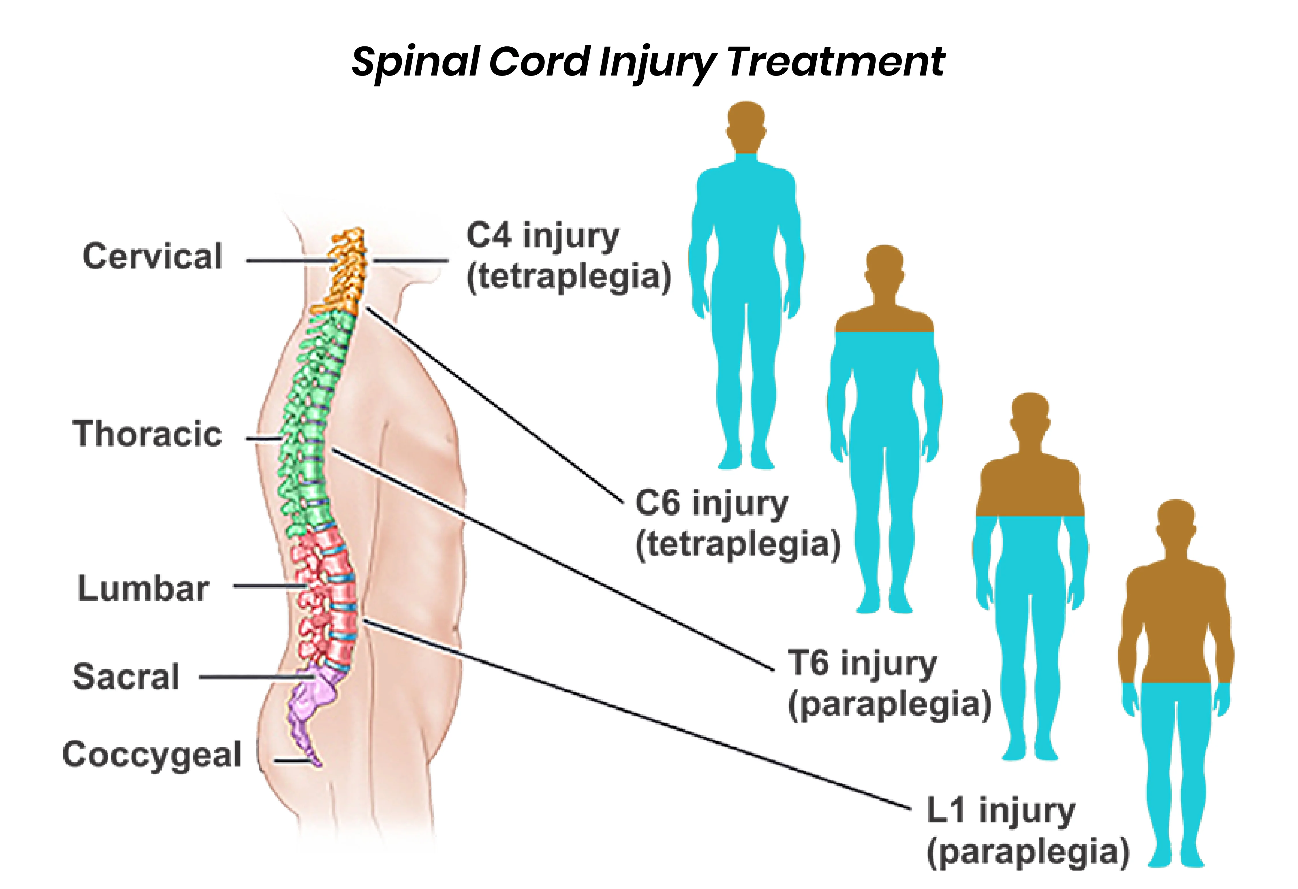 Spinal Cord Injury Treatment